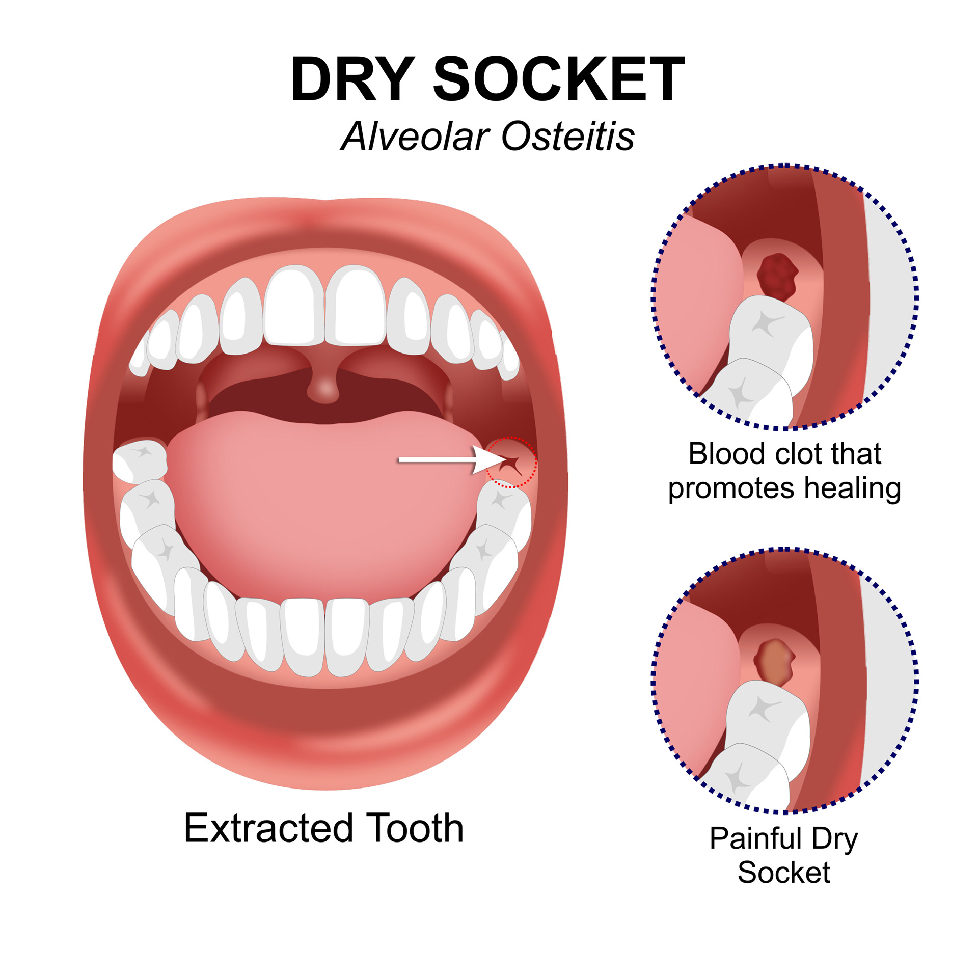 Alveolar Osteitis Antibiotics Alveolar Osteitis Antibiotics