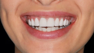Healthy gums and healthy teeth and gums